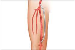 Mercado mundial de tratamiento de isquemia crítica de extremidades