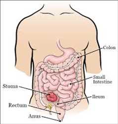 Mercado mundial de ileostomía