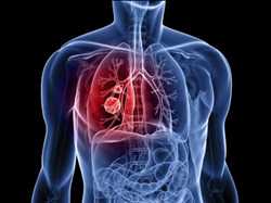 Mercado de cáncer de pulmón de células no pequeñas