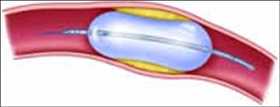 Perspectiva global del mercado Globos de angioplastia