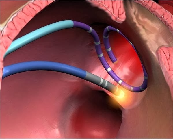 Cirugía de fibrilación auricular Tendencias de crecimiento del mercado