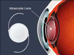 Crecimiento del mercado mundial de lentes intraoculares