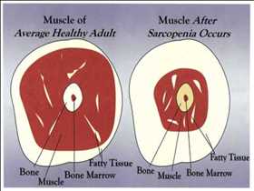 Demanda del mercado mundial de sarcopenia