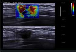 Mercado mundial de imágenes de elastografía