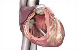 Mercado de Desfibrilador Cardioversor Implantable