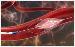 Mercado mundial de dispositivos neurovasculares