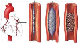 Mercado de stents vasculares