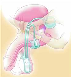 Perspectiva global del mercado de esfínteres urinarios artificiales