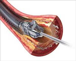 Perspectiva global del mercado de dispositivos de aterectomía