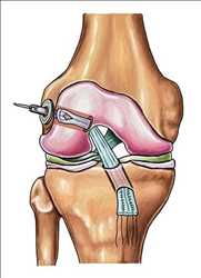 Pronóstico del mercado mundial de procedimientos de reparación de ligamentos cruzados