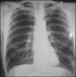 Análisis del mercado global de neumoconiosis