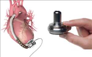 Demanda del mercado mundial de dispositivos de asistencia ventricular