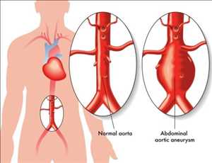 Crecimiento del mercado mundial de aneurisma aórtico