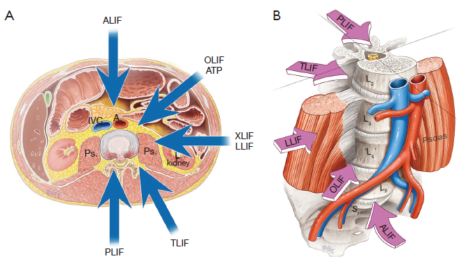 Crecimiento del mercado mundial de implantes DLIF y XLIF