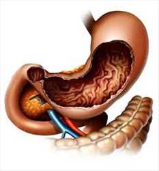 Demanda del mercado mundial Tratamiento de la gastroparesia diabética