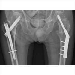 Perspectiva global del mercado Clavos intramedulares para la cadera