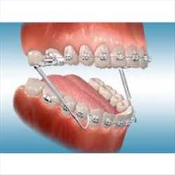 Demanda del mercado mundial de aparatos de ortodoncia
