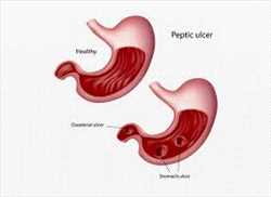 Análisis del mercado mundial de pruebas de úlcera péptica