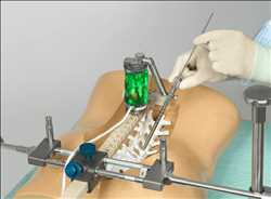 Tendencias del mercado mundial de robots quirúrgicos espinales
