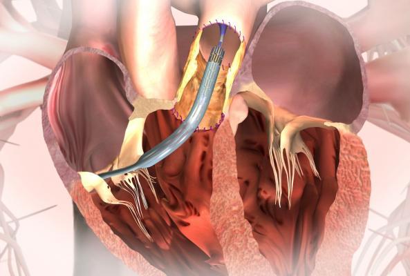 Perspectiva global del mercado de terapia de válvula pulmonar transcatéter (TPV)